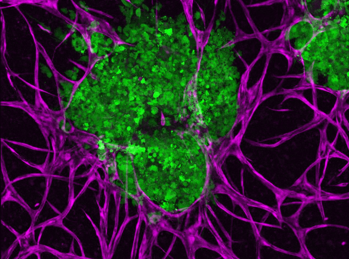 Penn State researchers 3D bioprinted breast cancer tumors (green) and cultivated their supportive microenvironments (purple) to better understand how they interact with one another. IMAGE: OZBOLAT LAB/PENN STATE