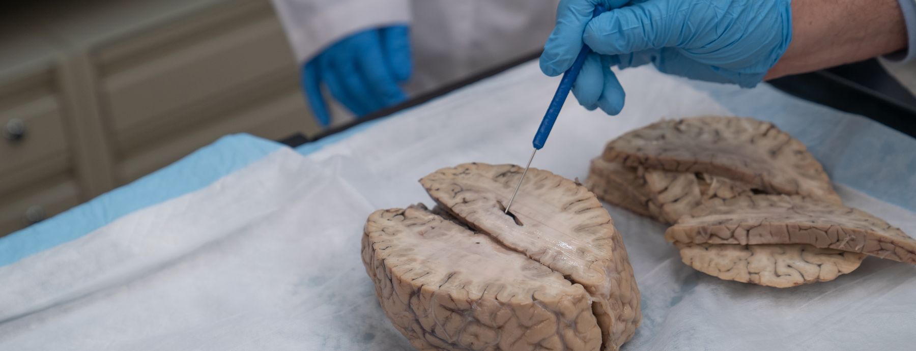 Human brain being dissected