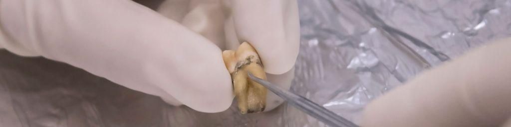 DNA analysis of dental tartar