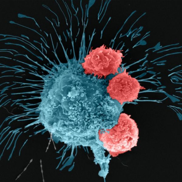 A scanning electron microscopy image shows a breast cancer cell (cyan) being attacked by T cells (red), which were engineered to recognize the cancer cells. Credit: Madhuri Dey, courtesy of the Ozbolat Lab/Penn State. All Rights Reserved.