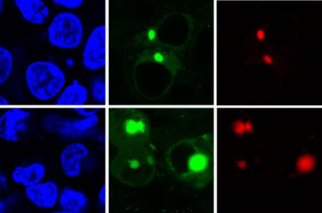 The new AggTag method allows researchers to see the previously undetectable but potentially disease-causing intermediate forms of proteins as they misfold. The method uses fluorescence to simultaneously detect two different proteins (red, green) within the cell (blue). Credit: Zhang lab, Penn State